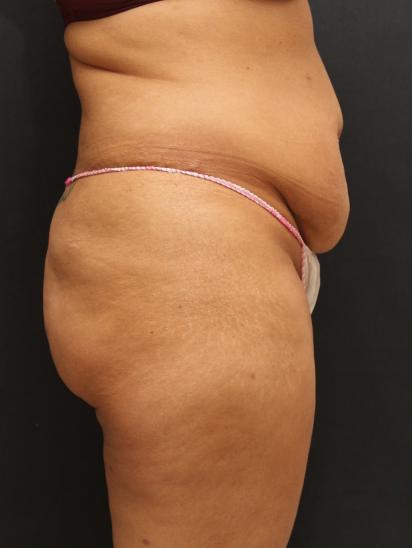 Liposuction Case 6852, Before Treatment, Female Patient, Set 5