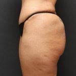 Liposuction Case 6852, After Treatment, Female Patient, Thumbnail 3