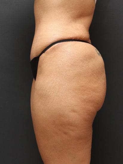 Liposuction Case 6852, After Treatment, Female Patient, Set 3