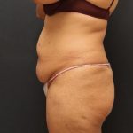 Liposuction Case 6852, Before Treatment, Female Patient, Thumbnail 3