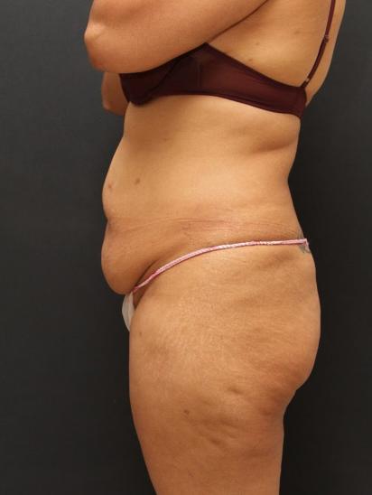Liposuction Case 6852, Before Treatment, Female Patient, Set 3