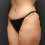 Liposuction Case 6852, After Treatment, Female Patient, Thumbnail 2