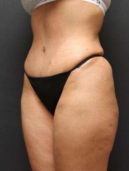 Liposuction Case 6852, After Treatment, Female Patient, Set 2