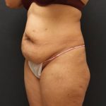Liposuction Case 6852, Before Treatment, Female Patient, Thumbnail 2