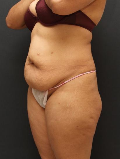 Liposuction Case 6852, Before Treatment, Female Patient, Set 2