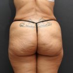 Liposuction Case 6852, After Treatment, Female Patient, Thumbnail 6