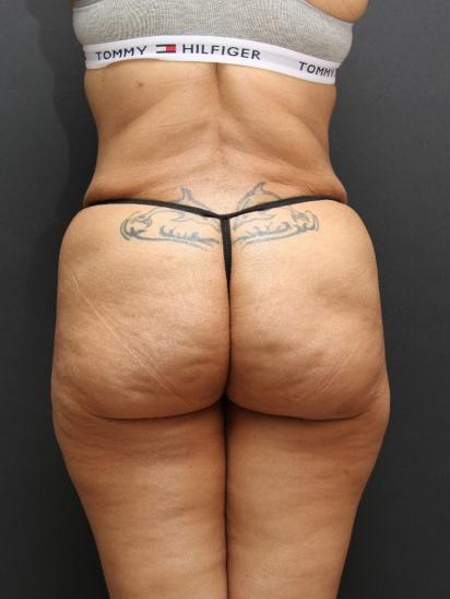 Liposuction Case 6852, After Treatment, Female Patient, Set 6