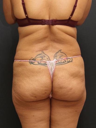 Liposuction Case 6852, Before Treatment, Female Patient, Set 6