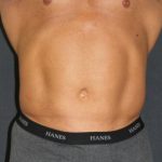Liposuction Case 6853, After Treatment, Male Patient, Thumbnail 1