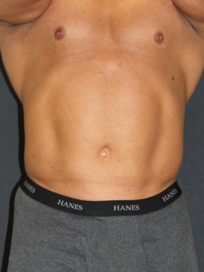 Body Plastic Surgery for Men After Photo