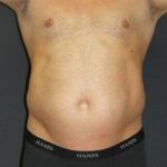 Liposuction Case 6853, Before Treatment, Male Patient, Thumbnail 1