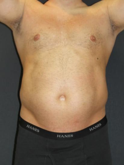 Body Plastic Surgery for Men Before Photo