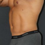 Liposuction Case 6853, After Treatment, Male Patient, Thumbnail 2