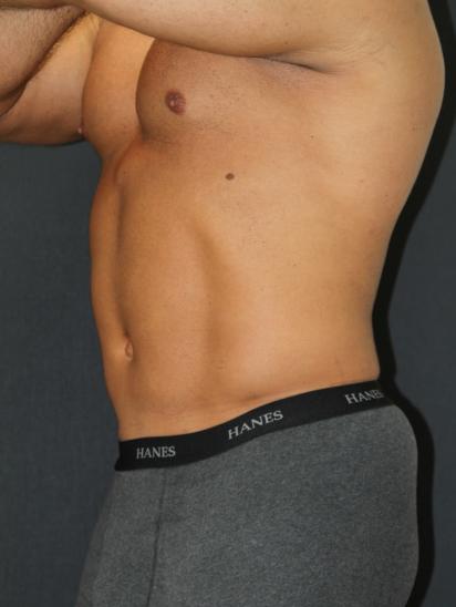 Liposuction Case 6853, After Treatment, Male Patient, Set 2