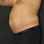 Liposuction Case 6853, Before Treatment, Male Patient, Thumbnail 2