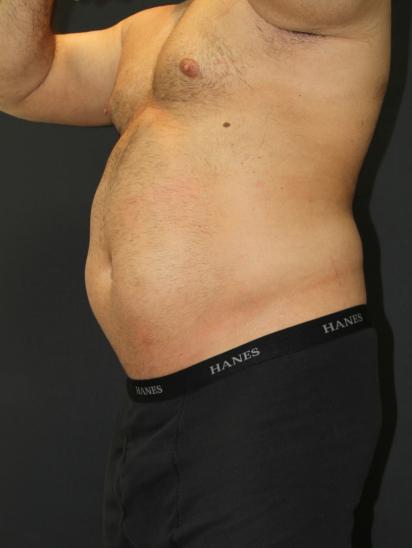 Liposuction Case 6853, Before Treatment, Male Patient, Set 2