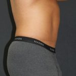 Liposuction Case 6853, After Treatment, Male Patient, Thumbnail 3