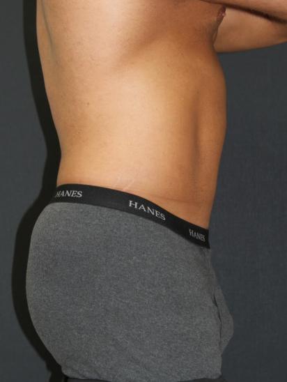 Liposuction Case 6853, After Treatment, Male Patient, Set 3