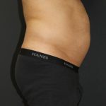Liposuction Case 6853, Before Treatment, Male Patient, Thumbnail 3