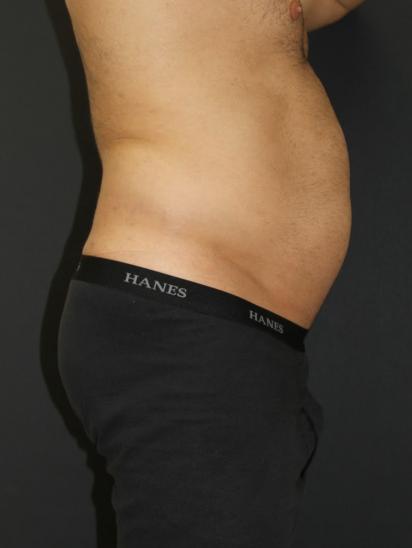 Liposuction Case 6853, Before Treatment, Male Patient, Set 3
