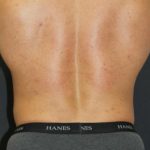 Liposuction Case 6853, After Treatment, Male Patient, Thumbnail 4