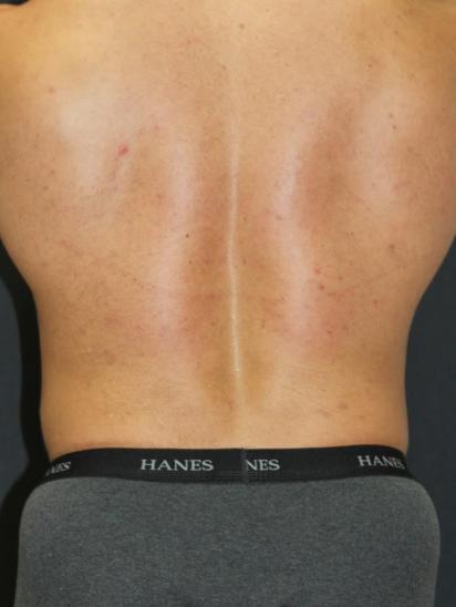 Liposuction Case 6853, After Treatment, Male Patient, Set 4