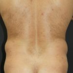 Liposuction Case 6853, Before Treatment, Male Patient, Thumbnail 4