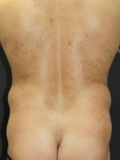 Liposuction Case 6853, Before Treatment, Male Patient, Set 4