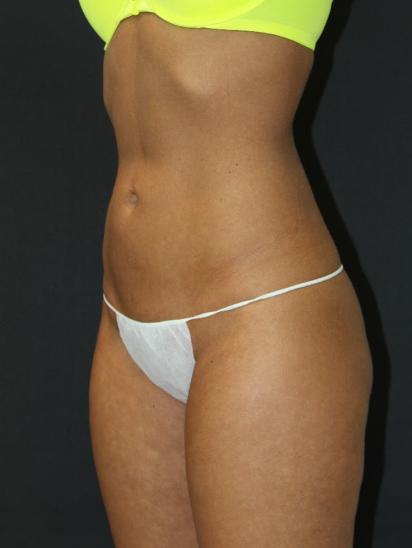 Liposuction Case 6854, After Treatment, Female Patient, Set 2