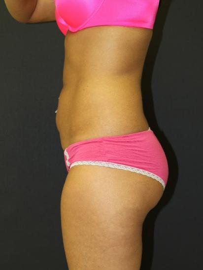 Liposuction Case 6854, Before Treatment, Female Patient, Set 3