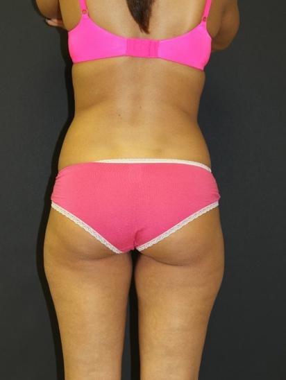 Liposuction Case 6854, Before Treatment, Female Patient, Set 6