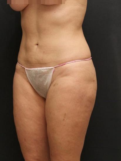 Liposuction Case 6855, After Treatment, Female Patient, Set 2