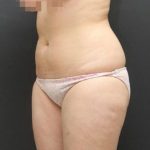 Liposuction Case 6855, Before Treatment, Female Patient, Thumbnail 2