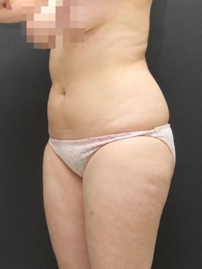 Liposuction Case 6855, Before Treatment, Female Patient, Set 2