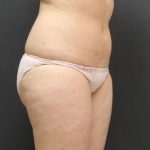 Liposuction Case 6855, Before Treatment, Female Patient, Thumbnail 4
