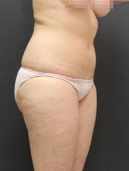 Liposuction Case 6855, Before Treatment, Female Patient, Set 4