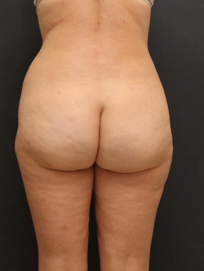 Liposuction Case 6855, After Treatment, Female Patient, Set 6