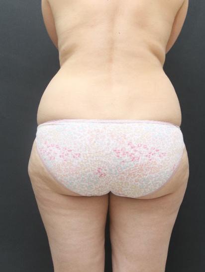 Liposuction Case 6855, Before Treatment, Female Patient, Set 6