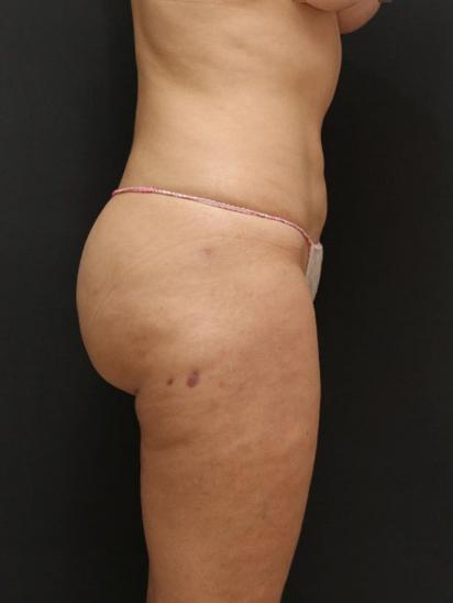 Liposuction Case 6855, After Treatment, Female Patient, Set 5