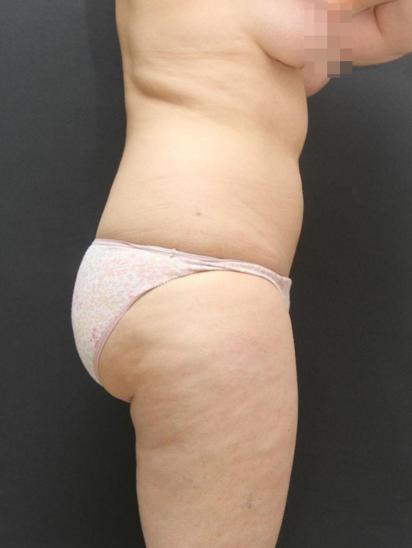 Liposuction Case 6855, Before Treatment, Female Patient, Set 5