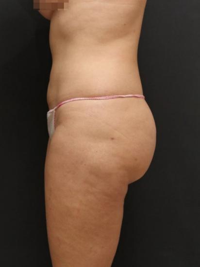 Liposuction Case 6855, After Treatment, Female Patient, Set 3