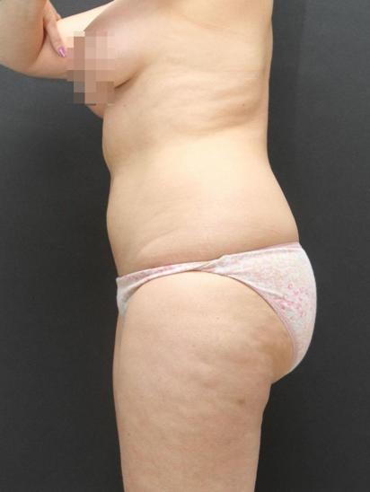 Liposuction Case 6855, Before Treatment, Female Patient, Set 3