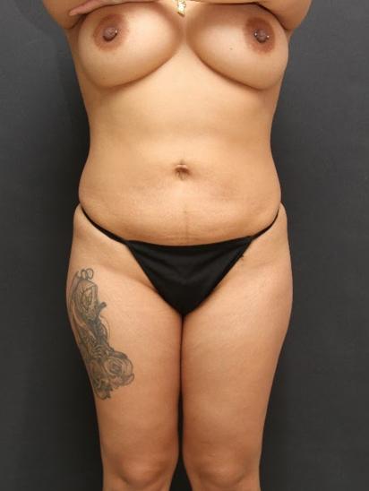 Main Photo Gallery, Case 6856, After Treatment