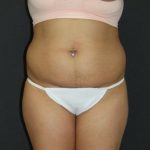 Liposuction Case 6856, Before Treatment, Female Patient, Thumbnail 1