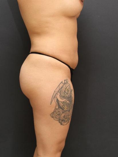 Liposuction Case 6856, After Treatment, Female Patient, Set 3