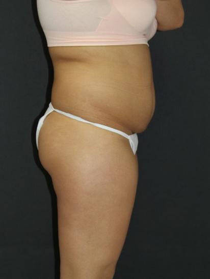 Liposuction Case 6856, Before Treatment, Female Patient, Set 3