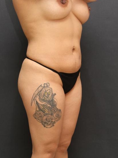 Liposuction Case 6856, After Treatment, Female Patient, Set 2