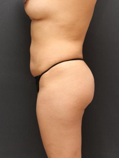 Liposuction Case 6856, After Treatment, Female Patient, Set 5