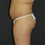 Liposuction Case 6856, Before Treatment, Female Patient, Thumbnail 5