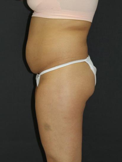 Liposuction Case 6856, Before Treatment, Female Patient, Set 5